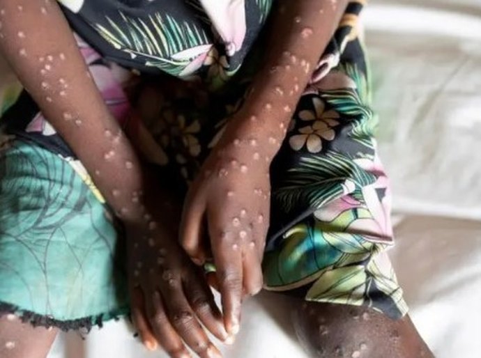 Suécia registra primeiro caso de nova variante da mpox fora da África: o que é a doença e como é transmitida?