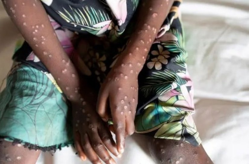 Suécia registra primeiro caso de nova variante da mpox fora da África: o que é a doença e como é transmitida?