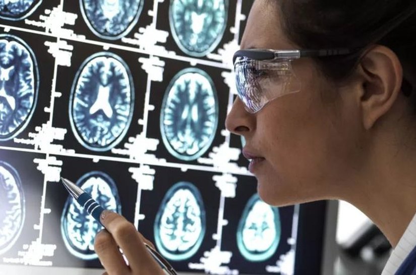 A nova droga que 'interrompe' evolução do Alzheimer