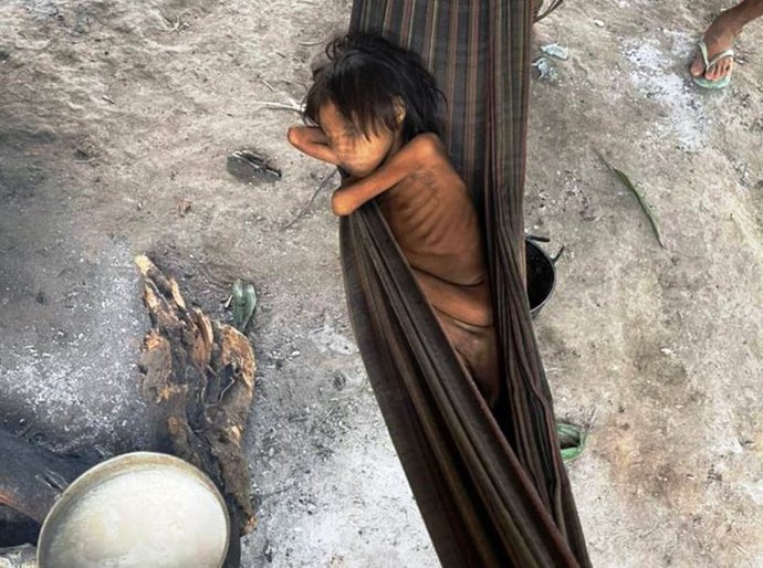 8 anos e 12 quilos, a criança com malária e desnutrição que simboliza o descaso com os Yanomami no Brasil