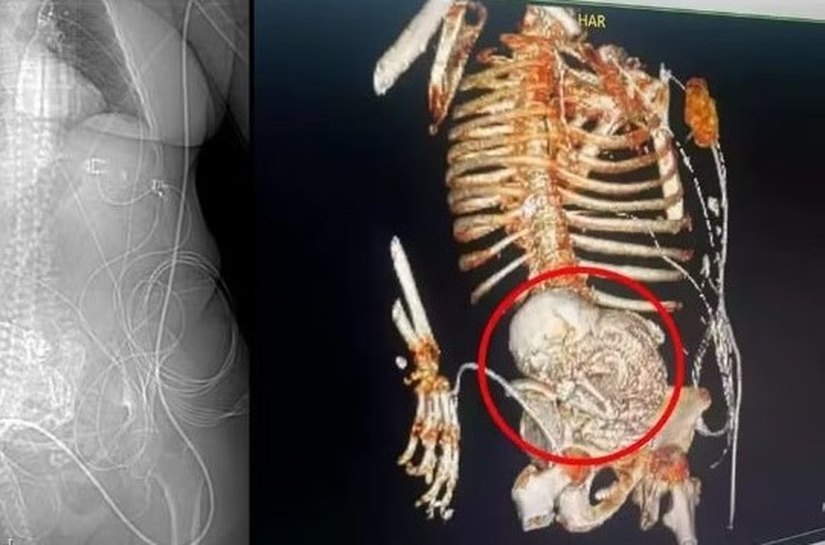 'Bebê de pedra': idosa descobre feto calcificado que carregou por mais de 5 décadas e morre após cirurgia de retirada