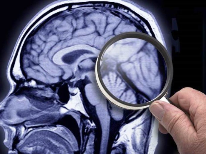 Alzheimer: saiba mais sobre a doença, seus sintomas, como preveni-la e tratá-la