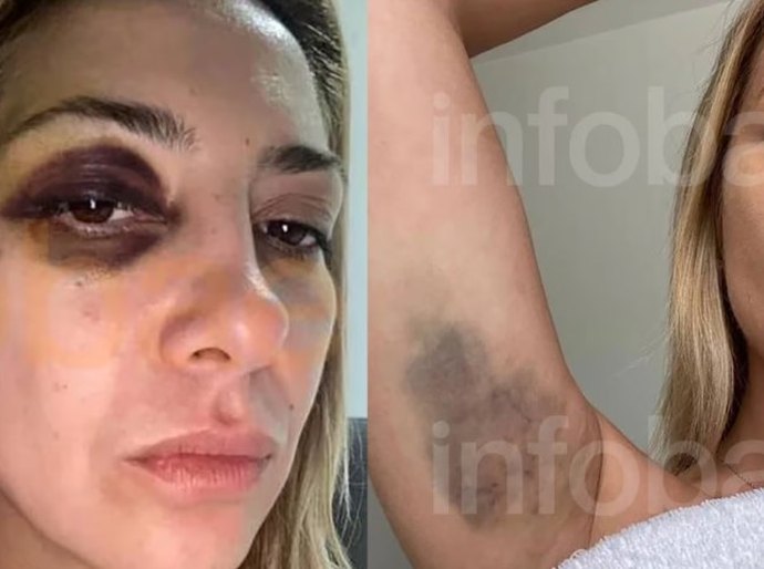 Fotos da ex-primeira-dama da Argentina mostram hematomas após agressões de Alberto Fernández, diz site