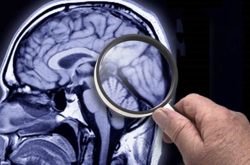 Alzheimer: saiba mais sobre a doença, seus sintomas, como preveni-la e tratá-la
