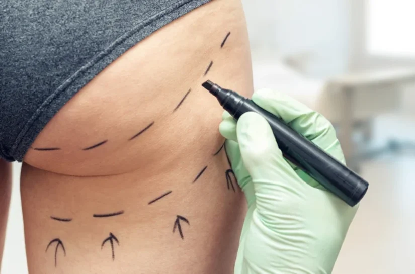 'Mãe, acho que vou morrer': o lado sombrio da febre do 'lifting de bumbum brasileiro' no Reino Unido