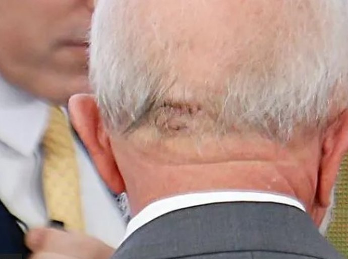 O que é hemorragia intracraniana, que fez Lula ser operado às pressas
