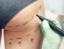 'Mãe, acho que vou morrer': o lado sombrio da febre do 'lifting de bumbum brasileiro' no Reino Unido