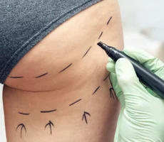'Mãe, acho que vou morrer': o lado sombrio da febre do 'lifting de bumbum brasileiro' no Reino Unido