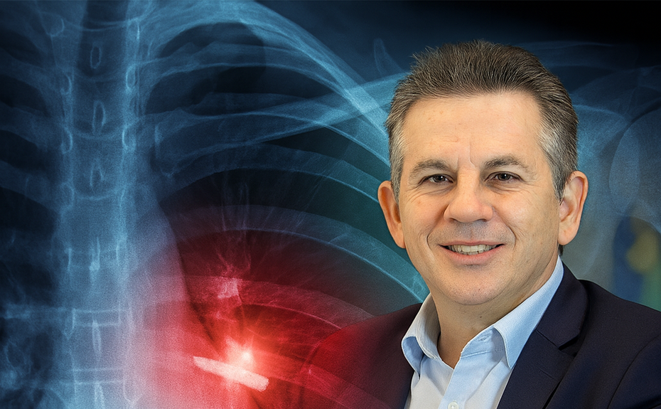 O que é uma fratura de costela? Entenda a lesão sofrida pelo governador Mauro Mendes