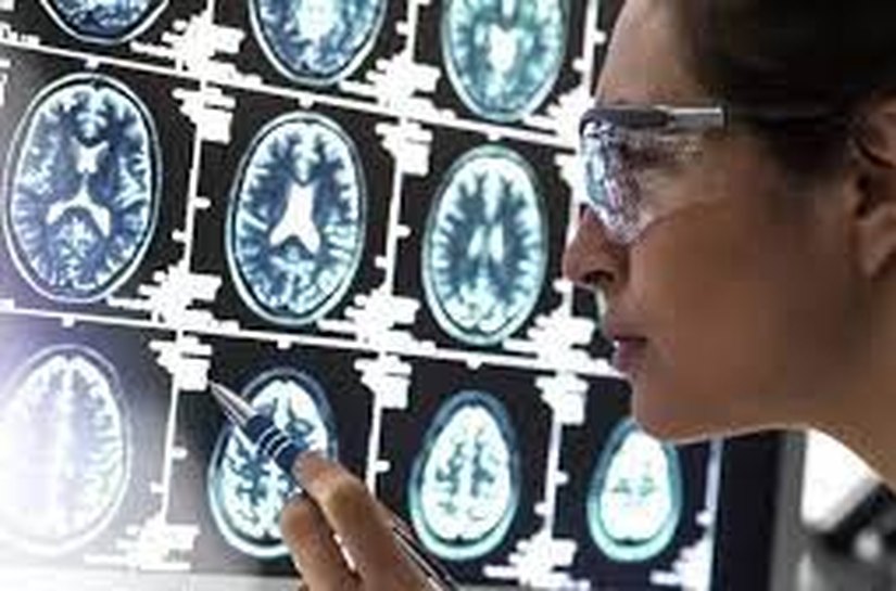 Cientistas podem ter desvendado enigma de como Alzheimer 'mata' neurônios