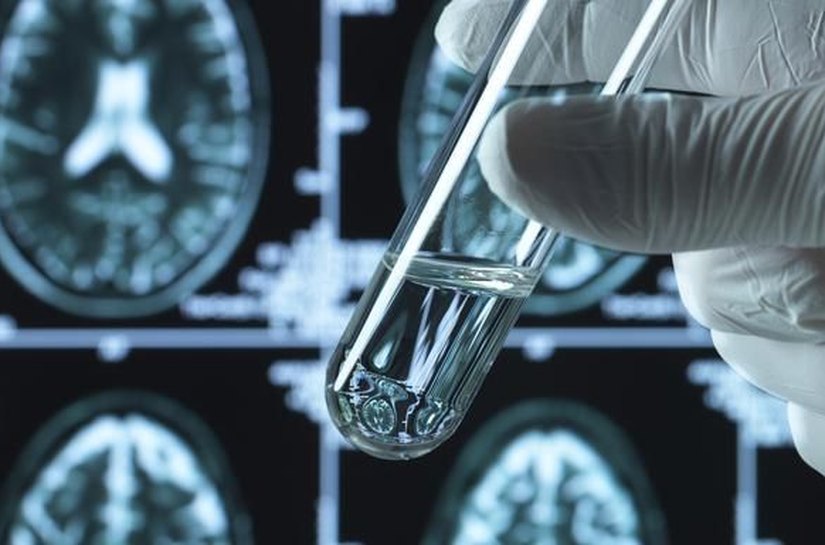 Alzheimer: uma notícia boa e três preocupações sobre os novos remédios