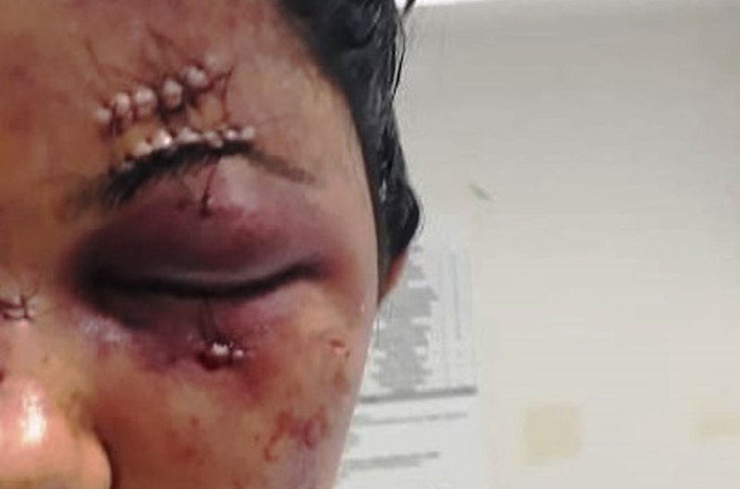 Rapaz de 21 ‘surra’ namorada de 18 por não aceitar fim do relacionamento; Polícia procura agressor