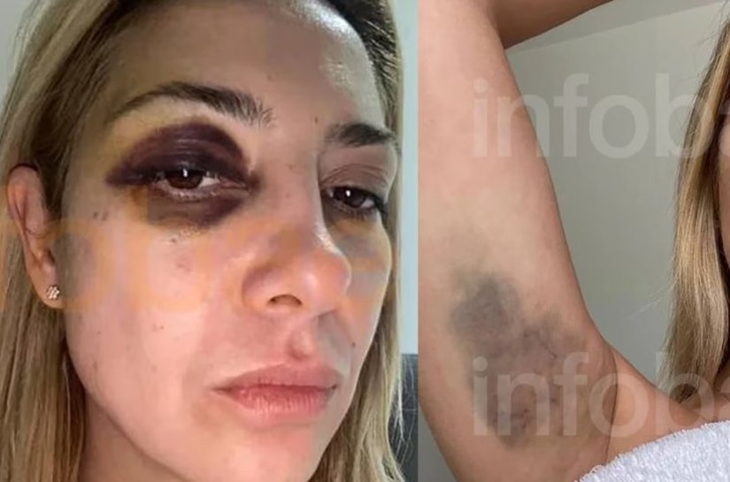 Fotos da ex-primeira-dama da Argentina mostram hematomas após agressões de Alberto Fernández, diz site