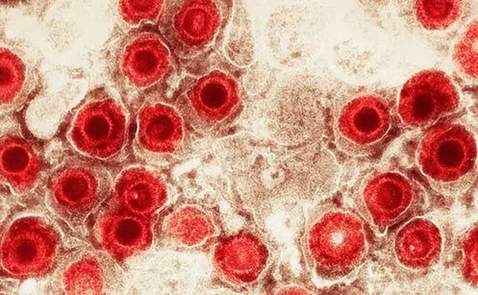 Vírus comuns podem aumentar o risco de Alzheimer?