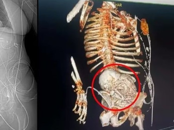 'Bebê de pedra': idosa descobre feto calcificado que carregou por mais de 5 décadas e morre após cirurgia de retirada