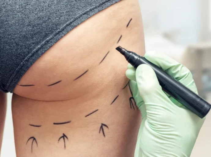 'Mãe, acho que vou morrer': o lado sombrio da febre do 'lifting de bumbum brasileiro' no Reino Unido