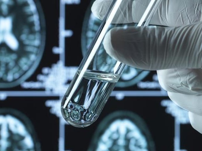Alzheimer: uma notícia boa e três preocupações sobre os novos remédios