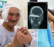 Idoso fica com faca presa dentro da cabeça durante 26 anos