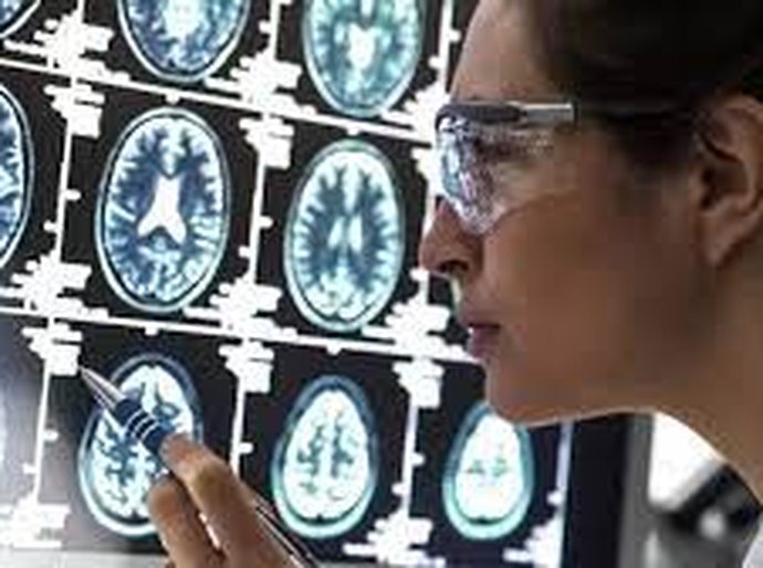Cientistas podem ter desvendado enigma de como Alzheimer 'mata' neurônios