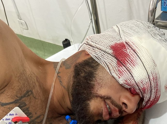 Explosão atinge em cheio o rosto de borracheiro e deixa jovem desacordado em Várzea Grande