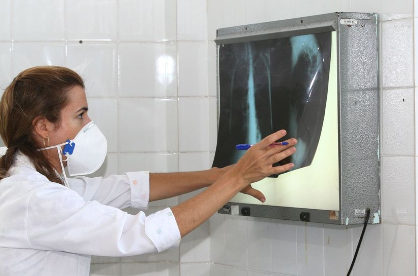 Com aumento de 5%, Brasil registra 78 mil casos de tuberculose
