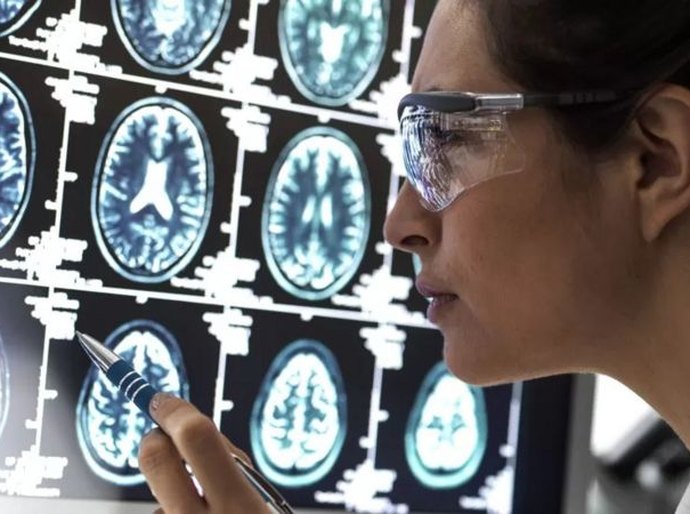 A nova droga que 'interrompe' evolução do Alzheimer